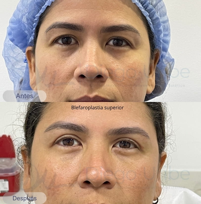 Blefaroplastia superior