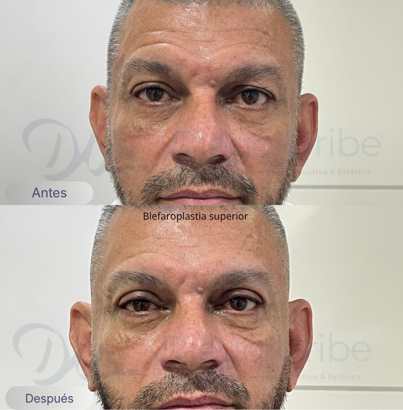 Blefaroplastia superior
