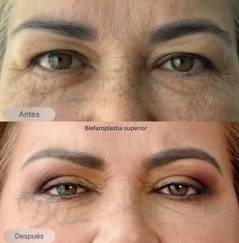 Blefaroplastia superior
