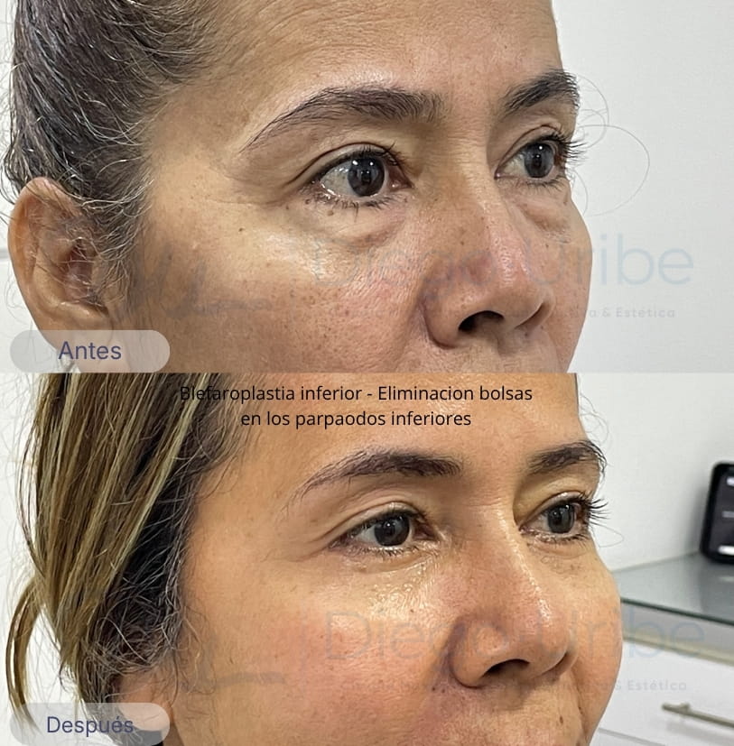Blefaroplastia inferior