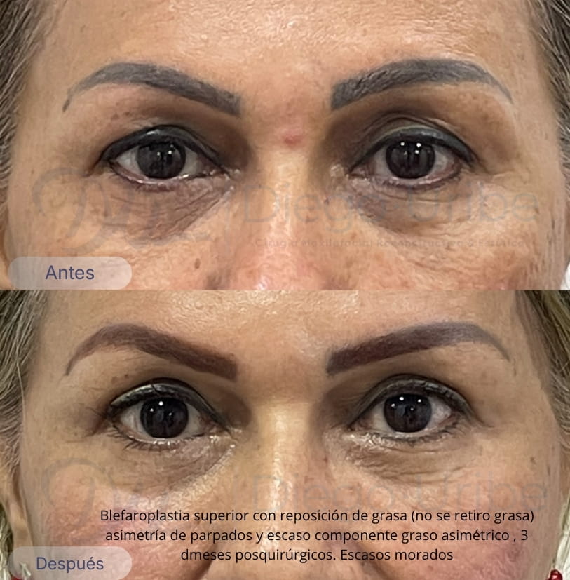 Blefaroplastia superior con reposición de grasa