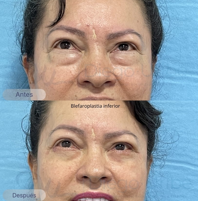Blefaroplastia inferior