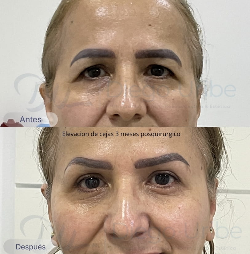 Elevación de cejas