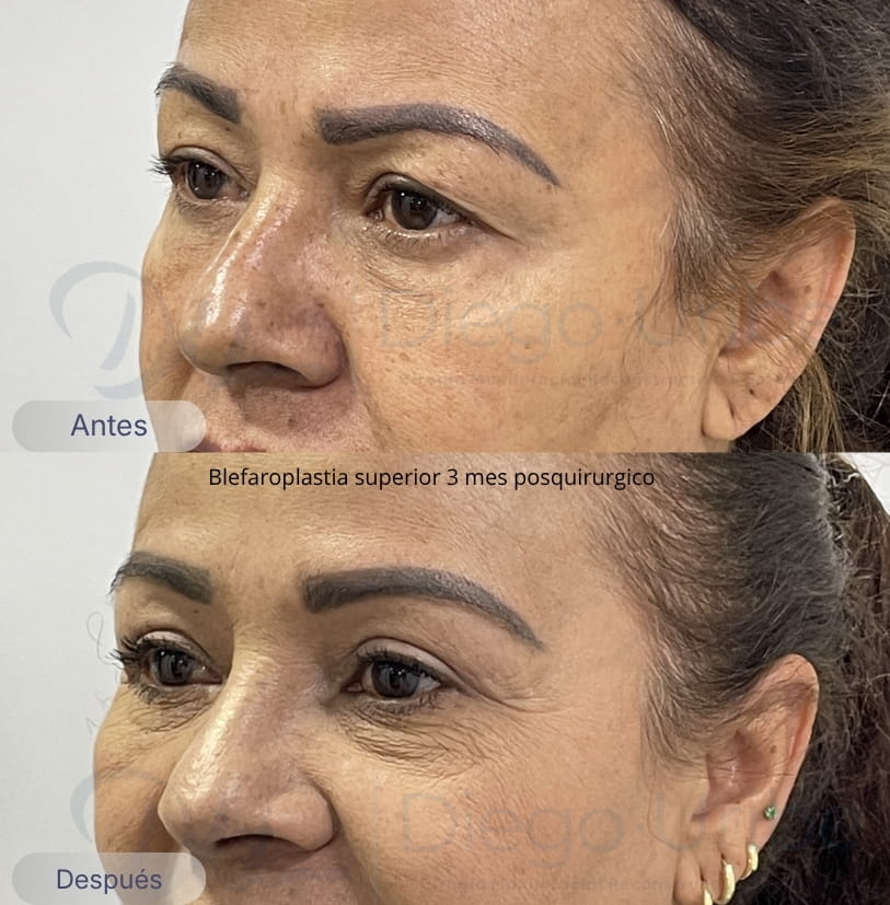Blefaroplastia superior
